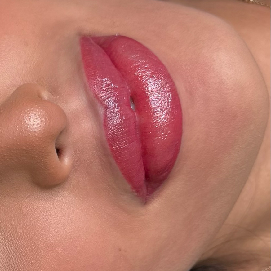 Lip neutralisation after treatment